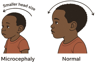 Understanding Microcephaly